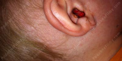 krwawienie z ucha filmy